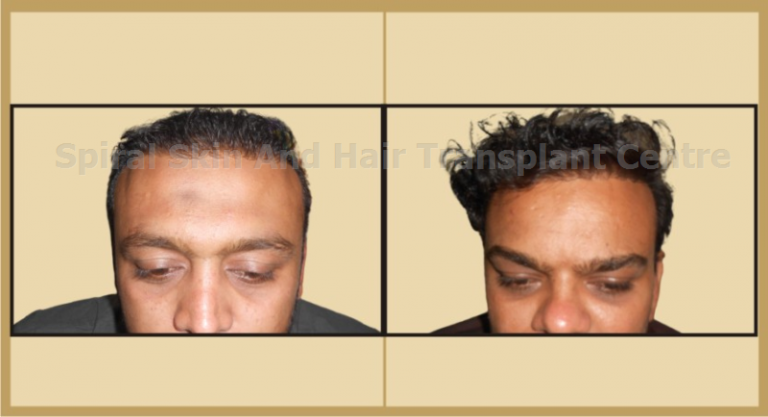 Spiral Skin And Hair Transplant Centre – Spiral Skin Clinic