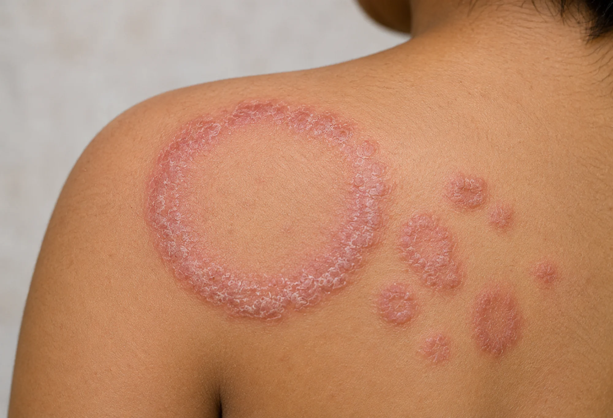skin fungal infection treatments