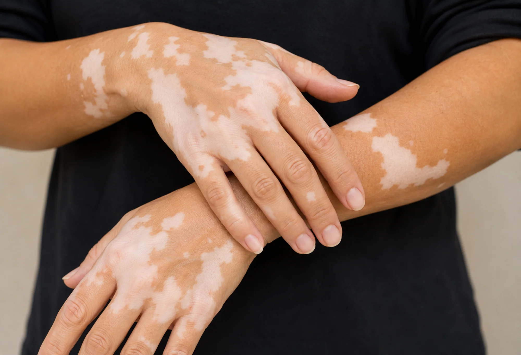 vitiligo treatments