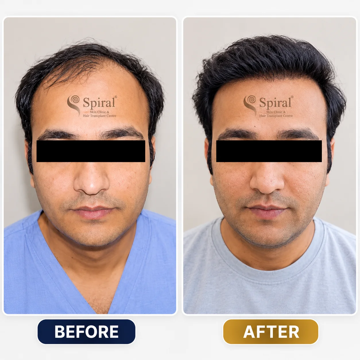 hair transplant result 1
