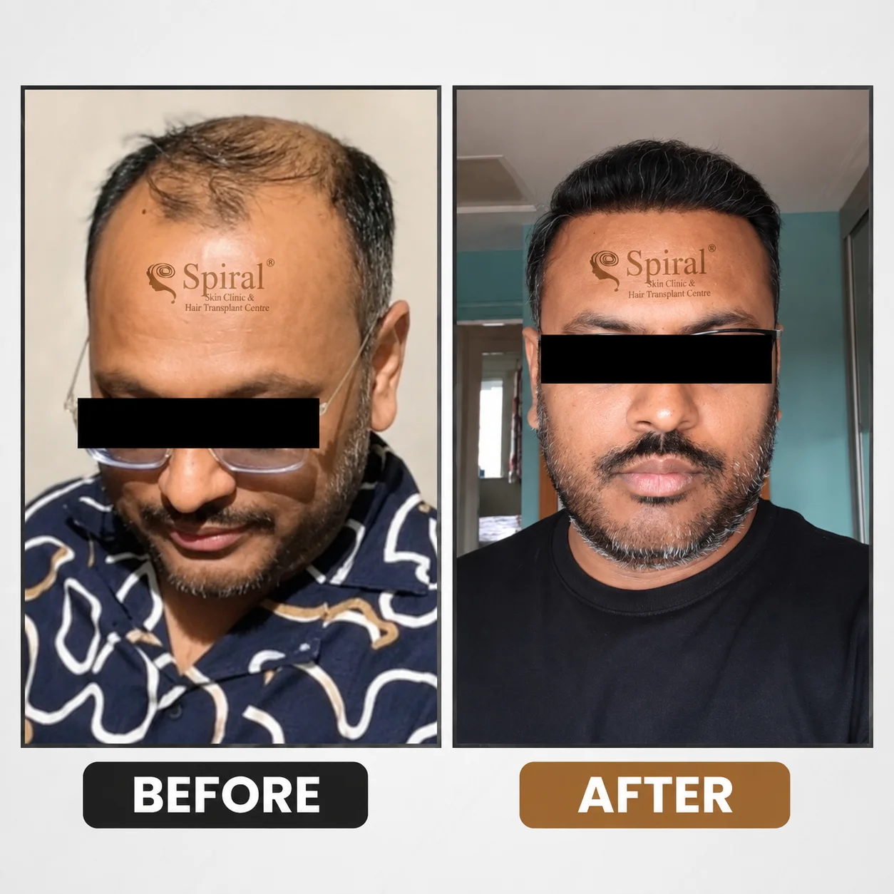 hair transplant result 10