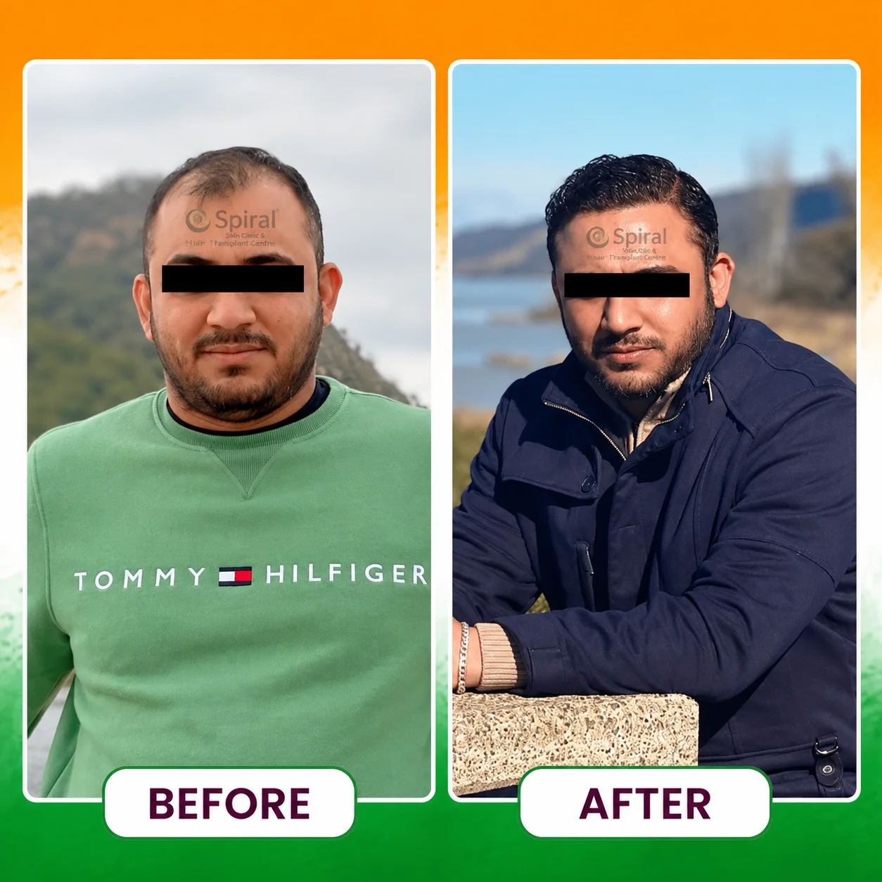 hair transplant result 11