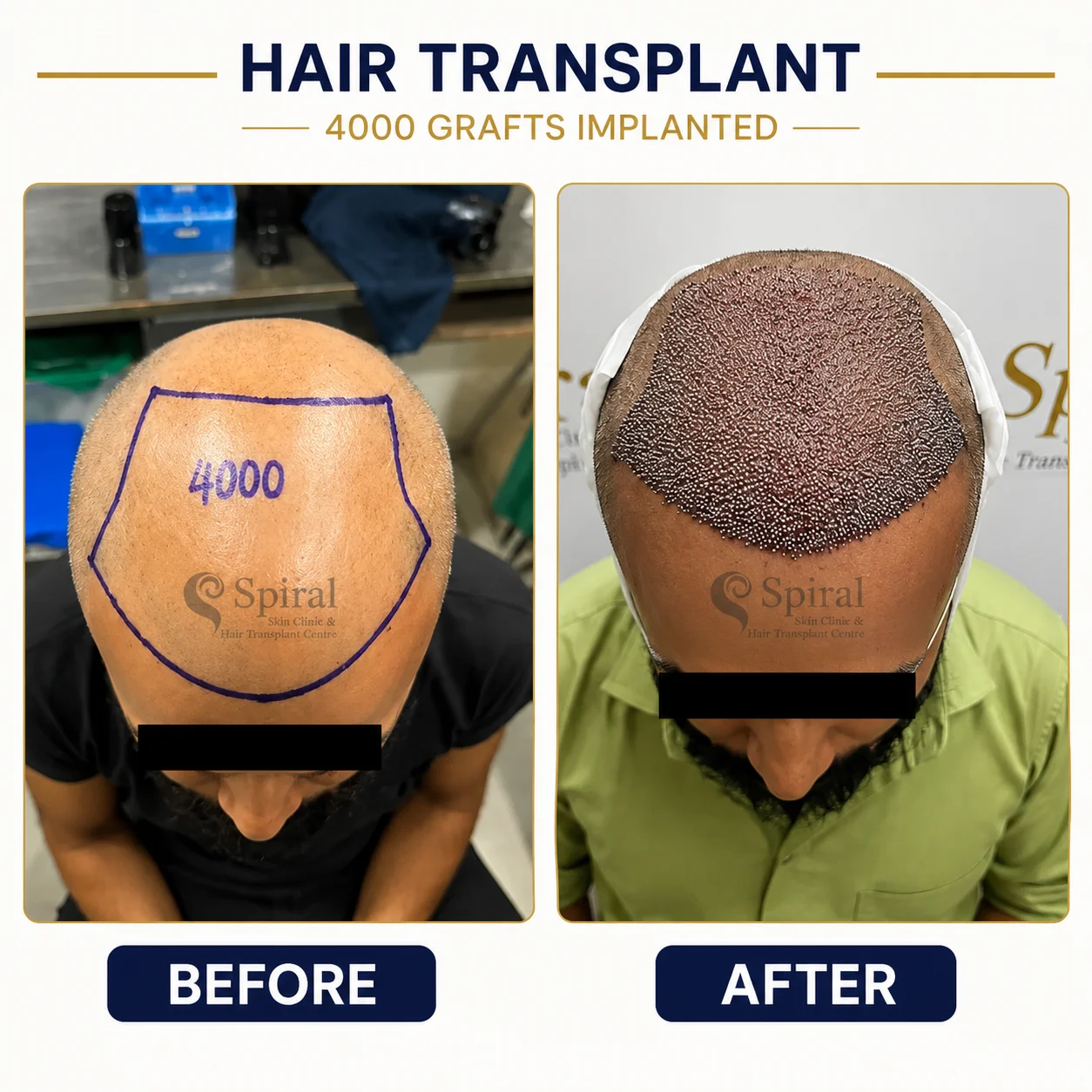 hair transplant result 12