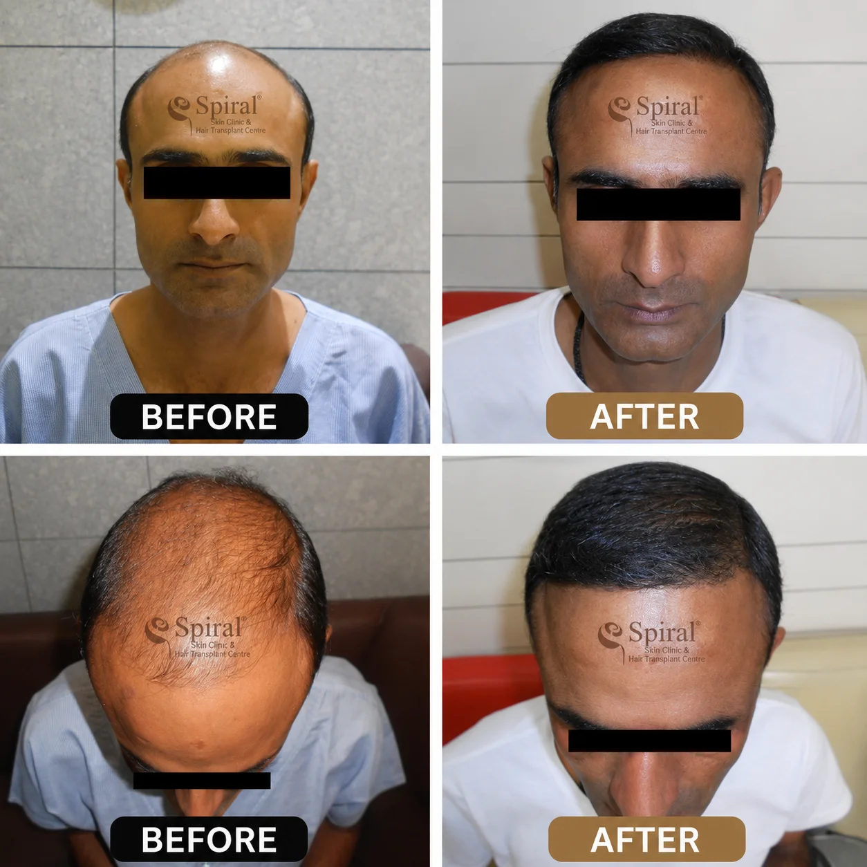hair transplant result 2