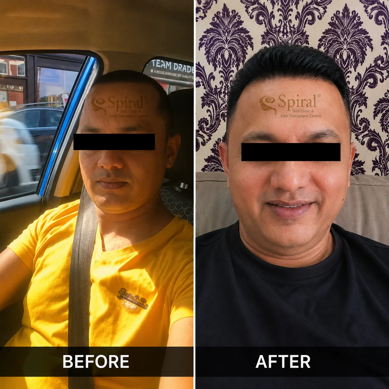 hair transplant result 3