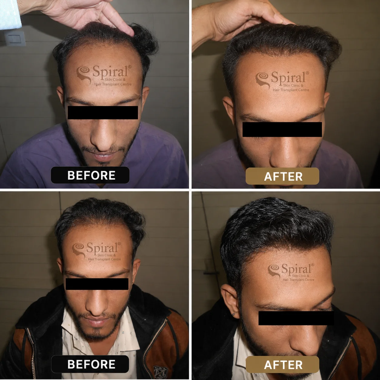 hair transplant result 4