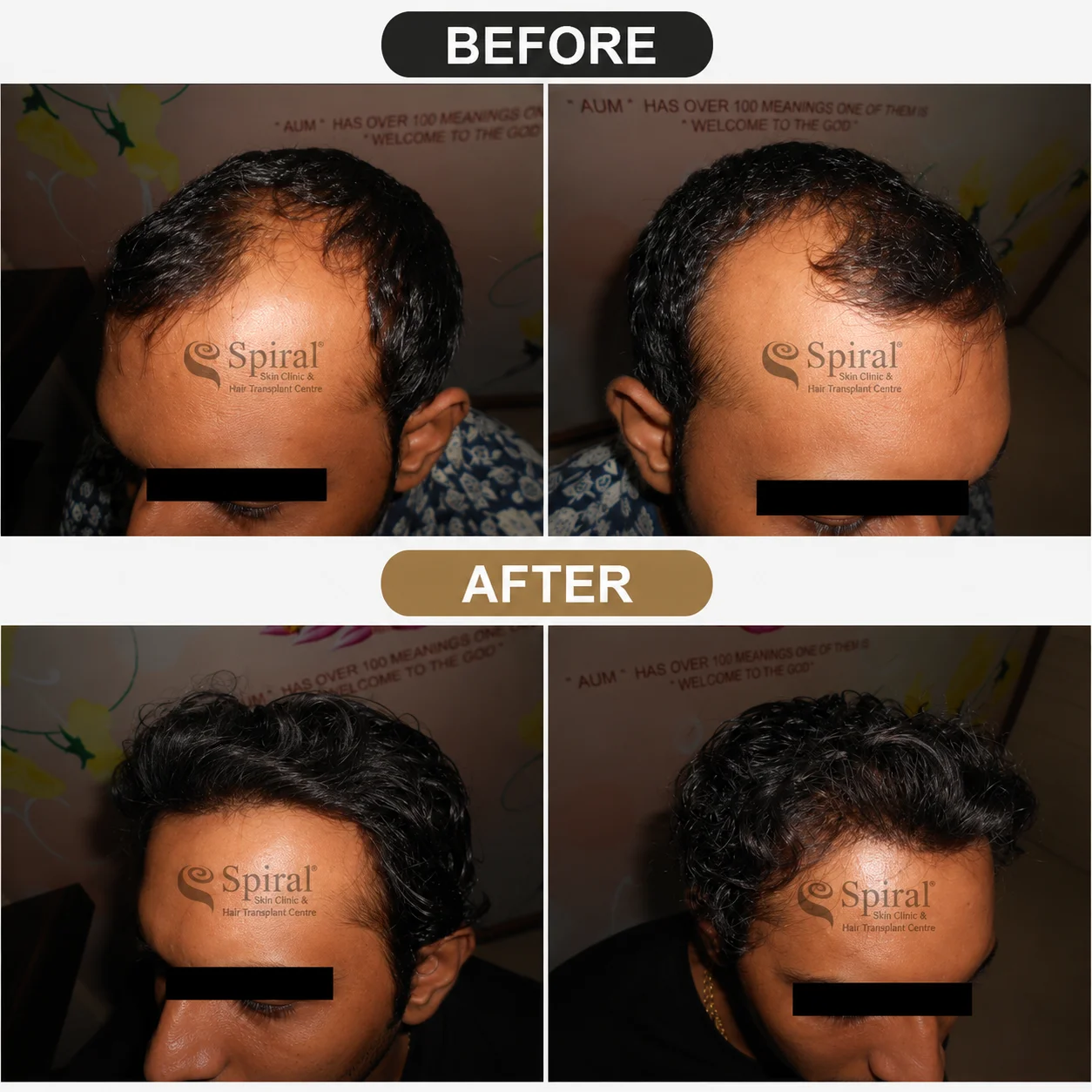 hair transplant result 5