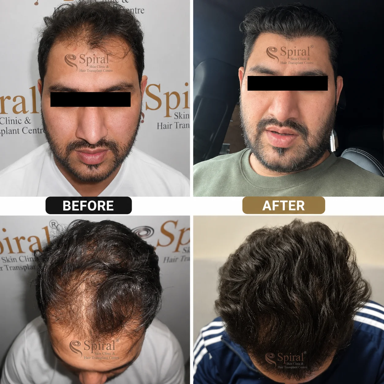 hair transplant result 6
