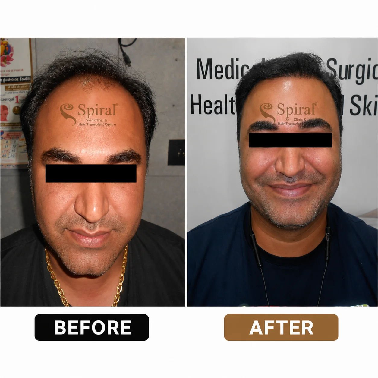 hair transplant result 7