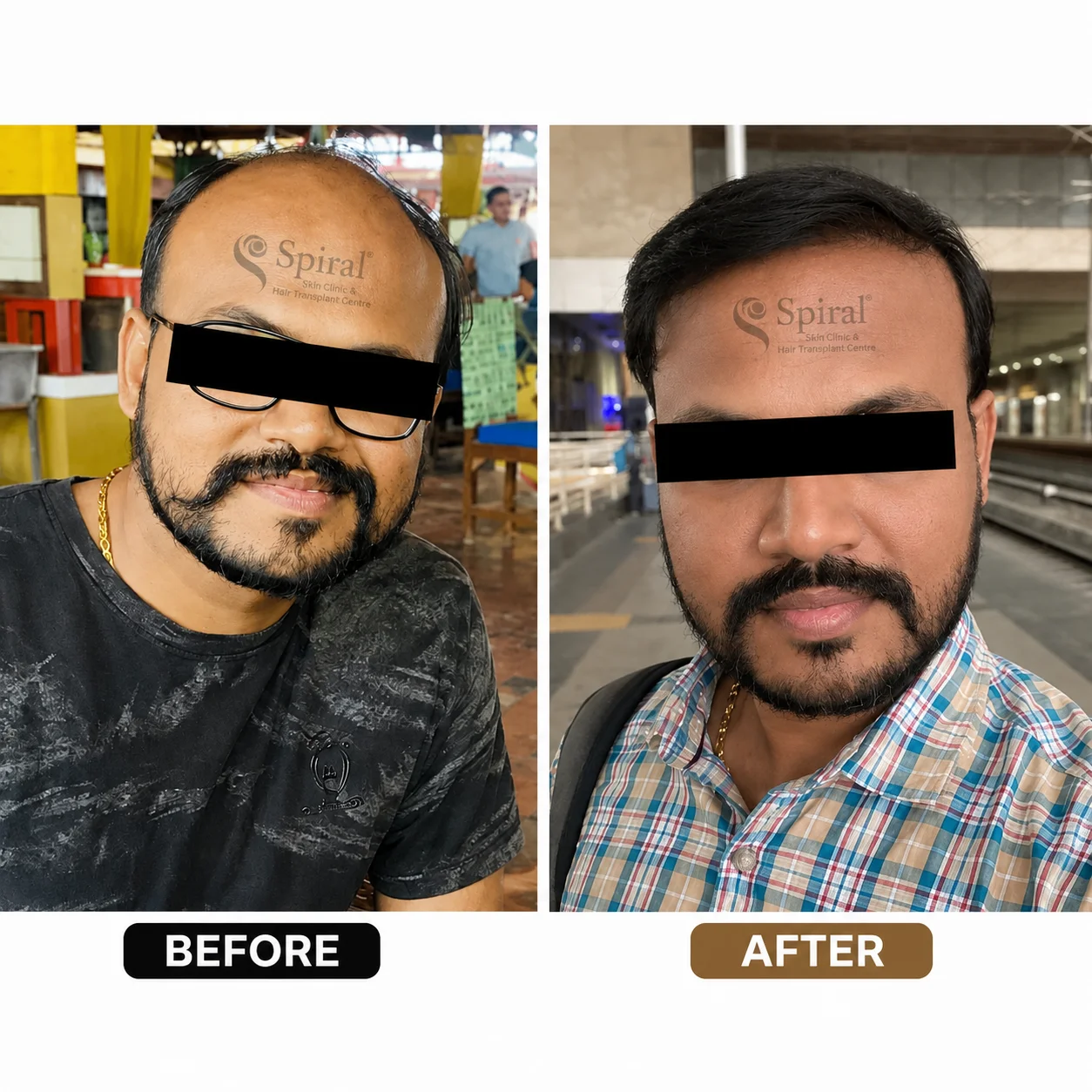 hair transplant result 8