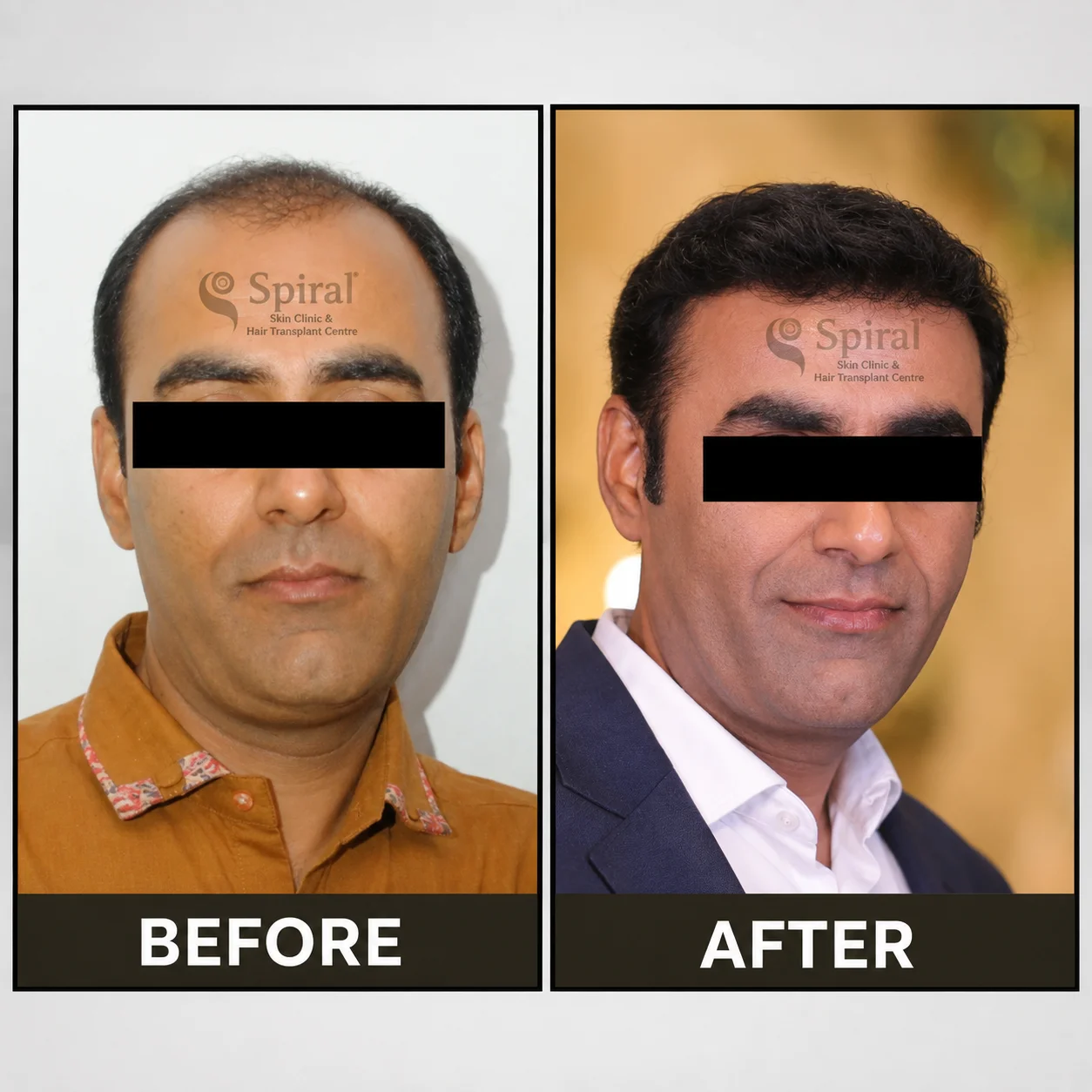 hair transplant result 9